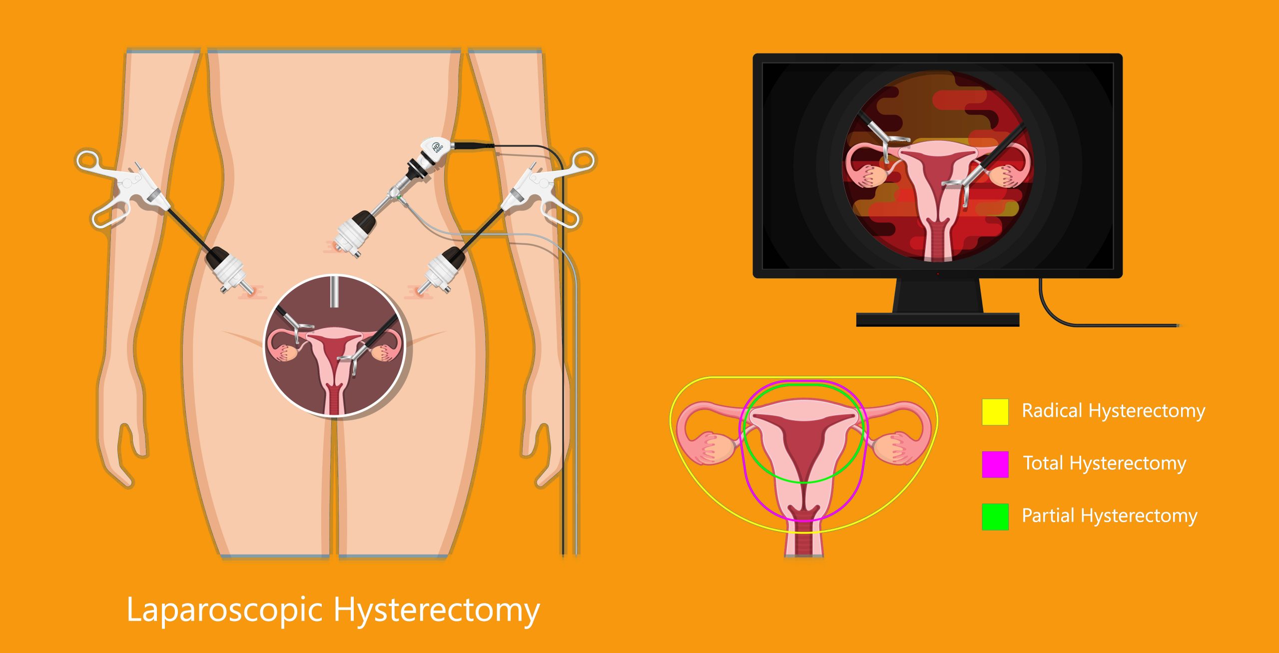 hysterectomy in dubai - Dr Pranjali Singh