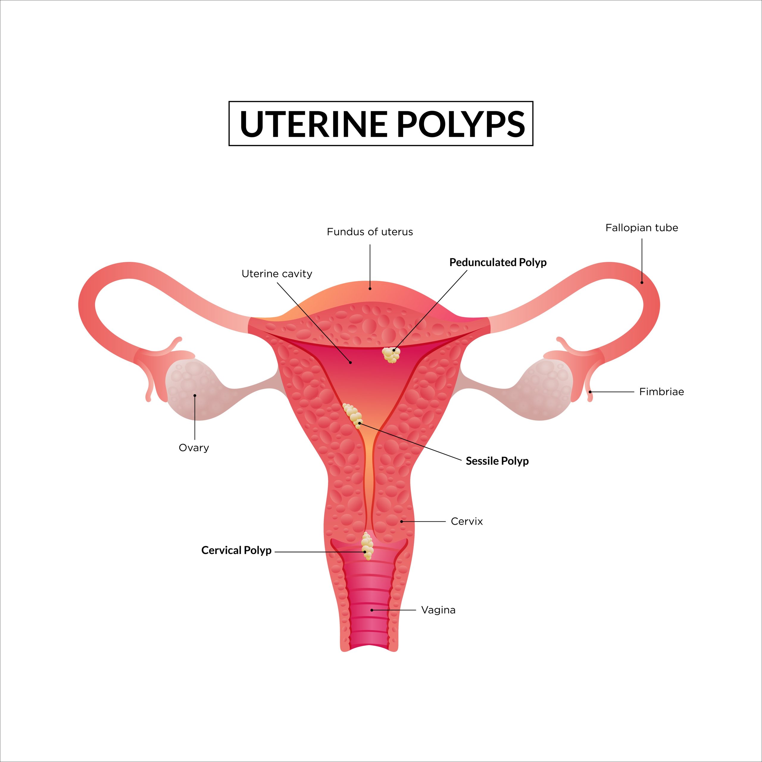 uterine polyps treatment in dubai - dr pranjali singh