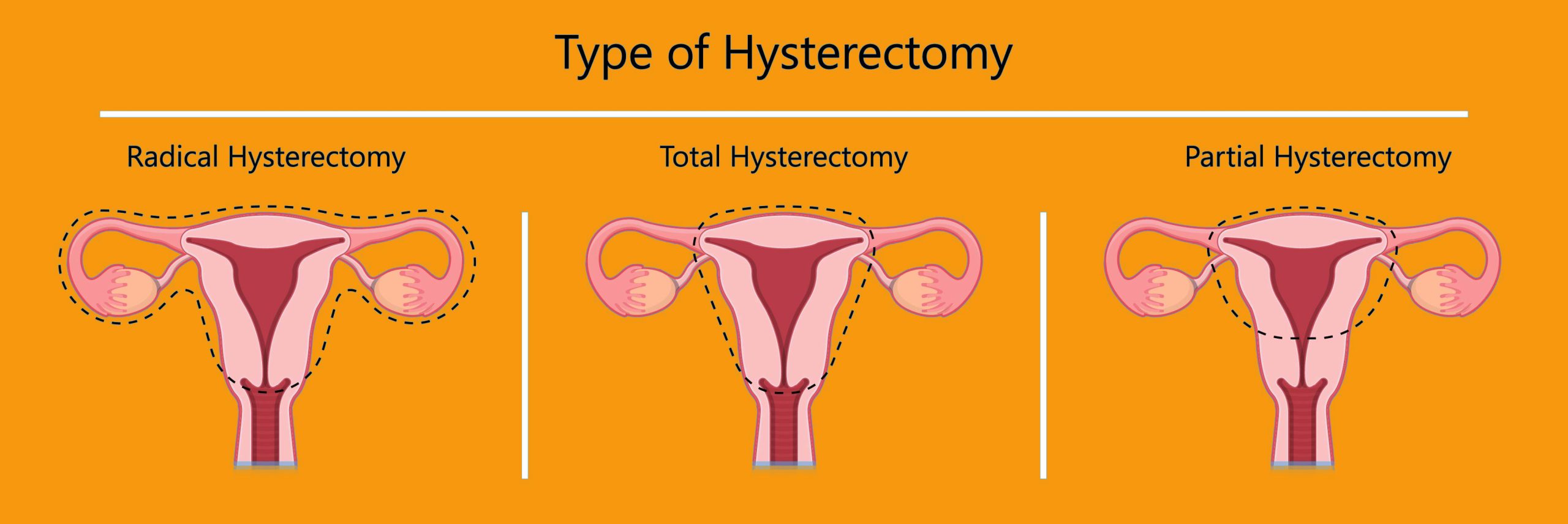 hysterectomy cost in dubai, Types of Hysterectomy - Dr Pranjali Singh