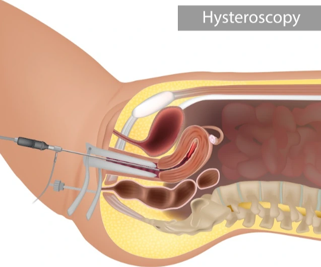 hysteroscopic septal resection in Dubai - Dr Pranjali Singh