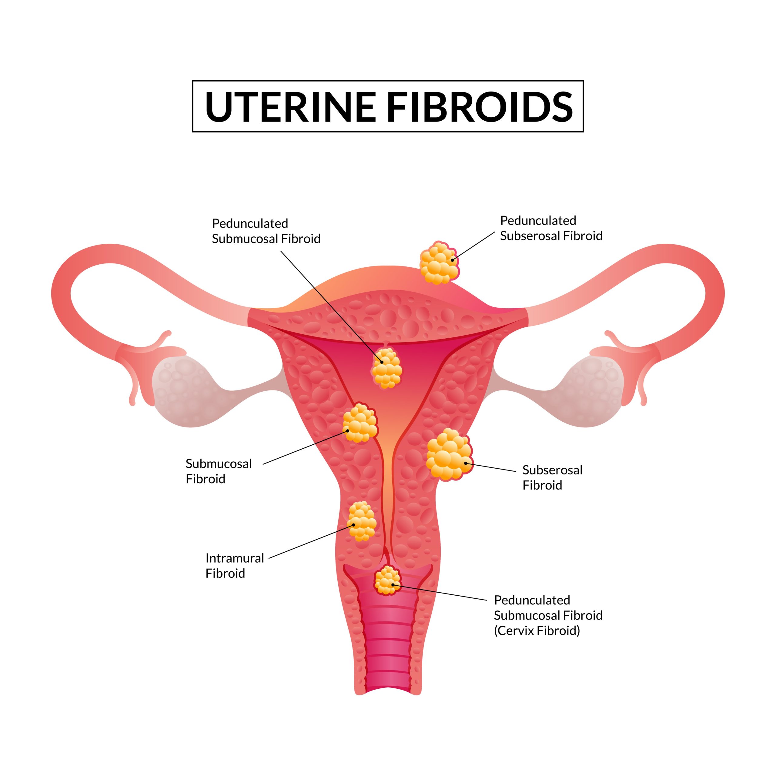 fibroids treatment in dubai - dr pranjali singh
