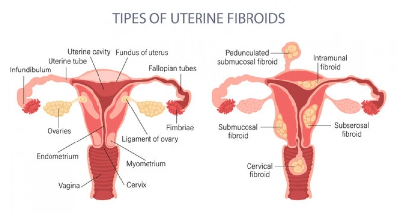 hysteroscopic resection of fibroids - Dr Pranjali Singh